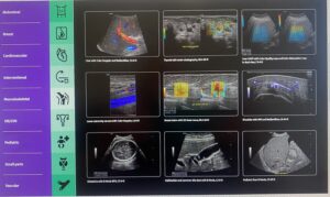 Νέος υπερηχοτομογράφος GE HealthCare LOGIQ E10s στο Γενικό Νοσοκομείο Χανίων (φώτο)