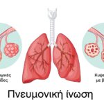 Η Περιφέρεια Κρήτης συμμετέχει και στηρίζει την εκστρατεία ενημέρωσης για την Πευμονική Ίνωση