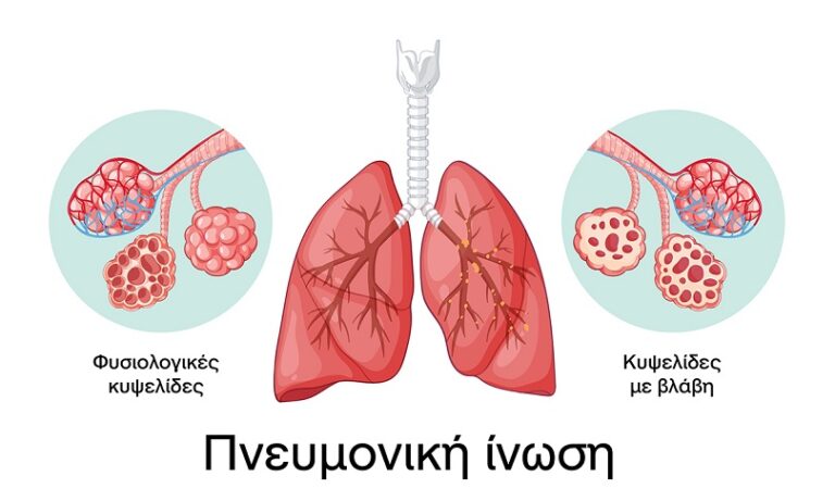 Η Περιφέρεια Κρήτης συμμετέχει και στηρίζει την εκστρατεία ενημέρωσης για την Πευμονική Ίνωση